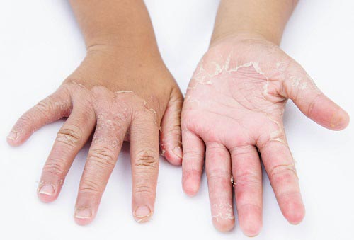 Dry hands, peel, Contact dermatitis, fungal infections, Skin inf