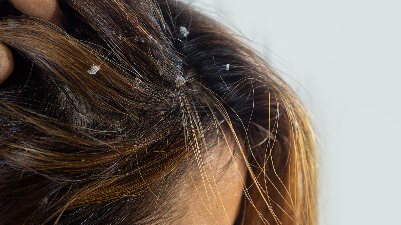 effective dandruff shampoos